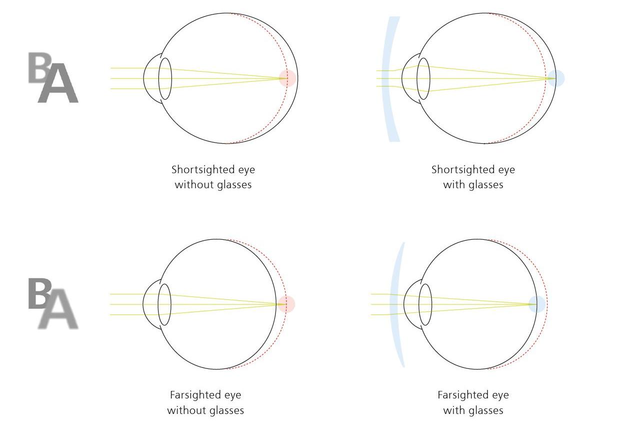 An illustration taken from the "My Vision Experience by ZEISS" booklet showing fairsighted eyes with and without glasses in a comparison