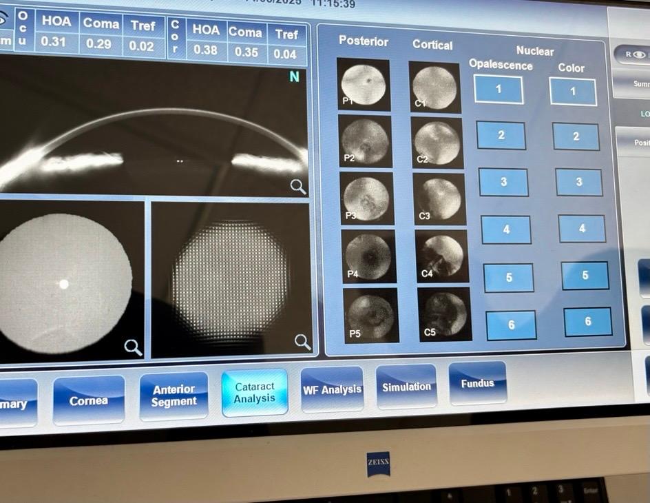 Caesar Vision System Cataracts and New Screening Opportunities from ZEISS