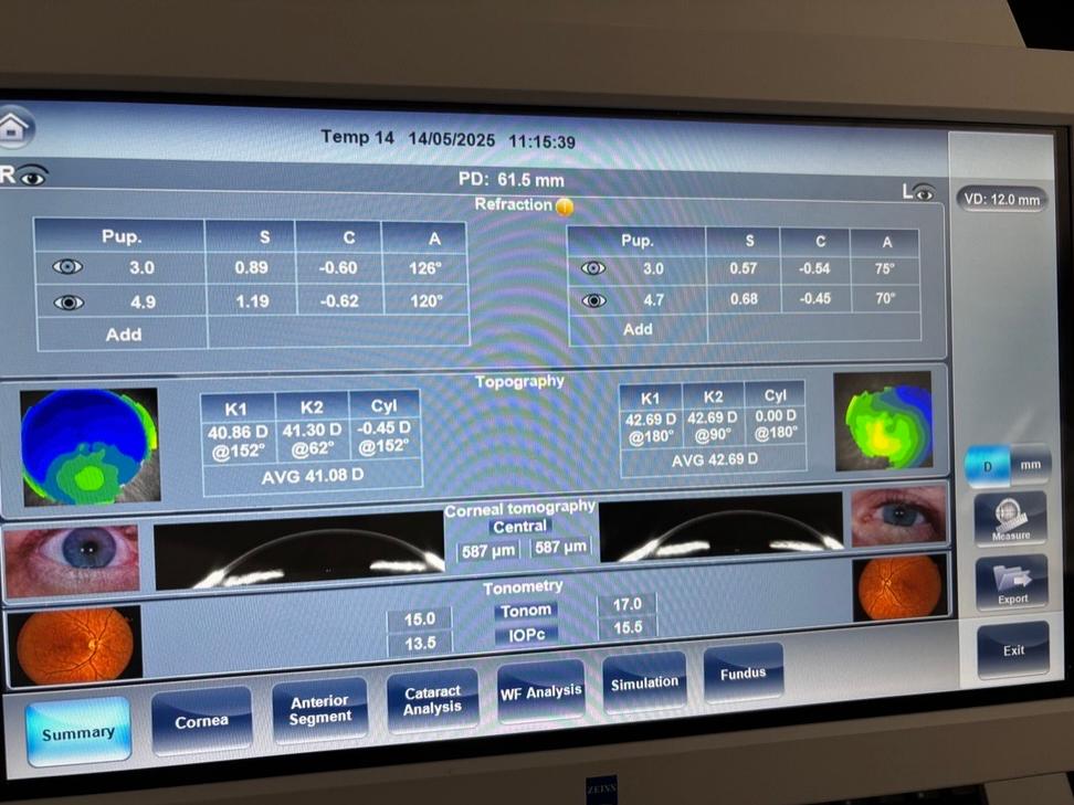 Caesar Vision System Cataracts and New Screening Opportunities from ZEISS