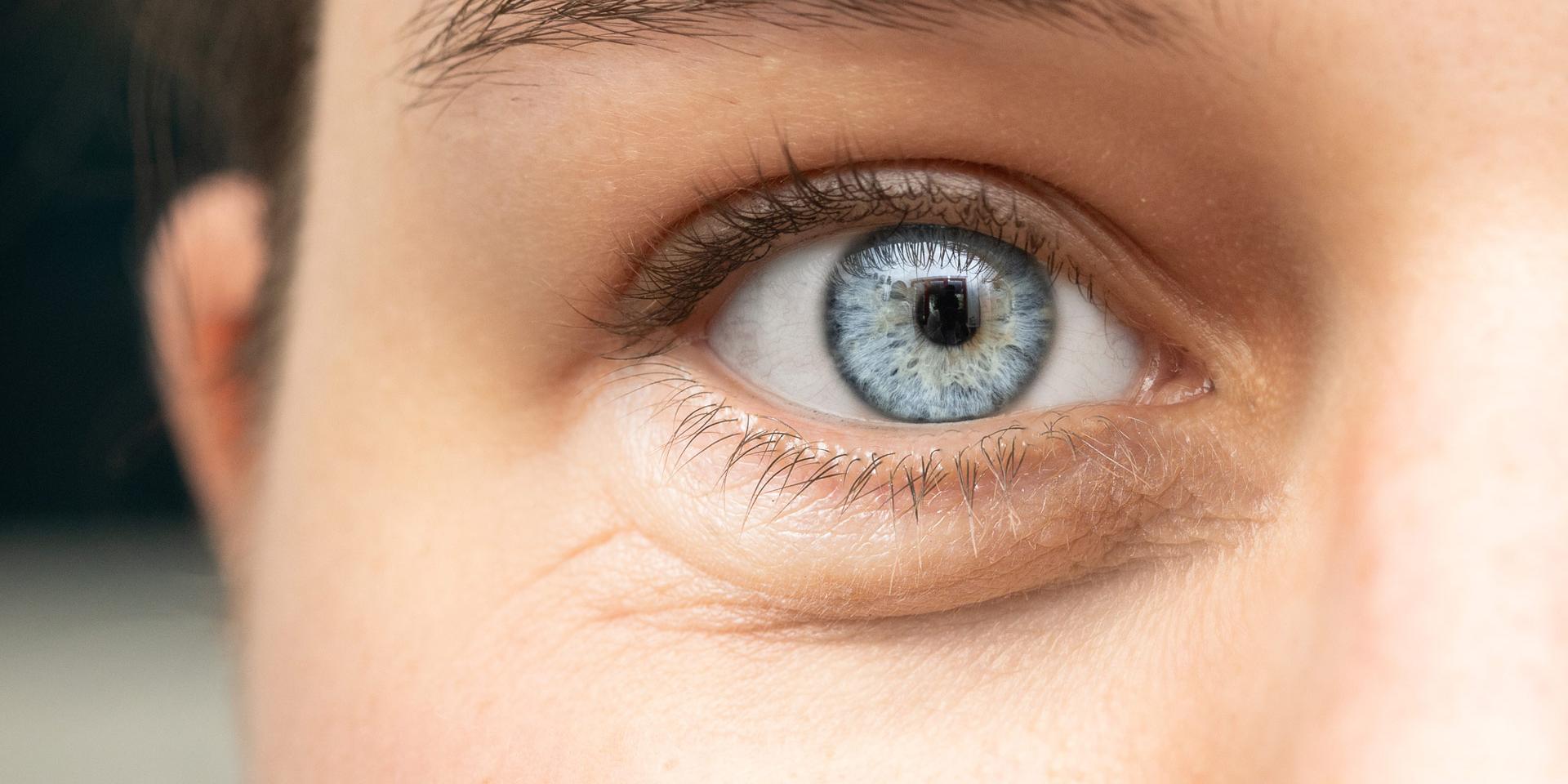 Swollen eyes dark circles red and burning eyes
