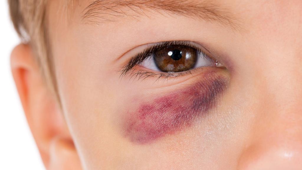 Unexplained bruising around eye socket discount