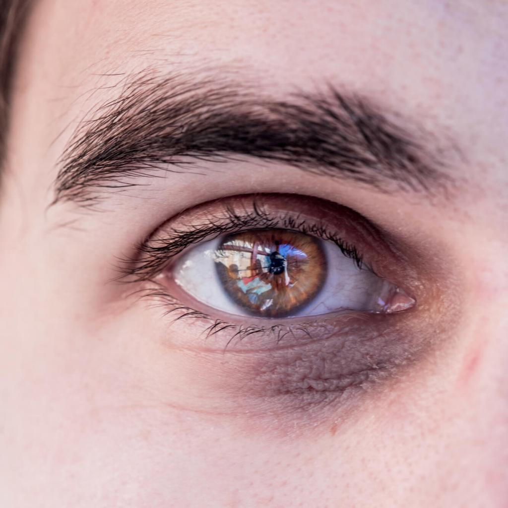 Bruised eye hot sale
