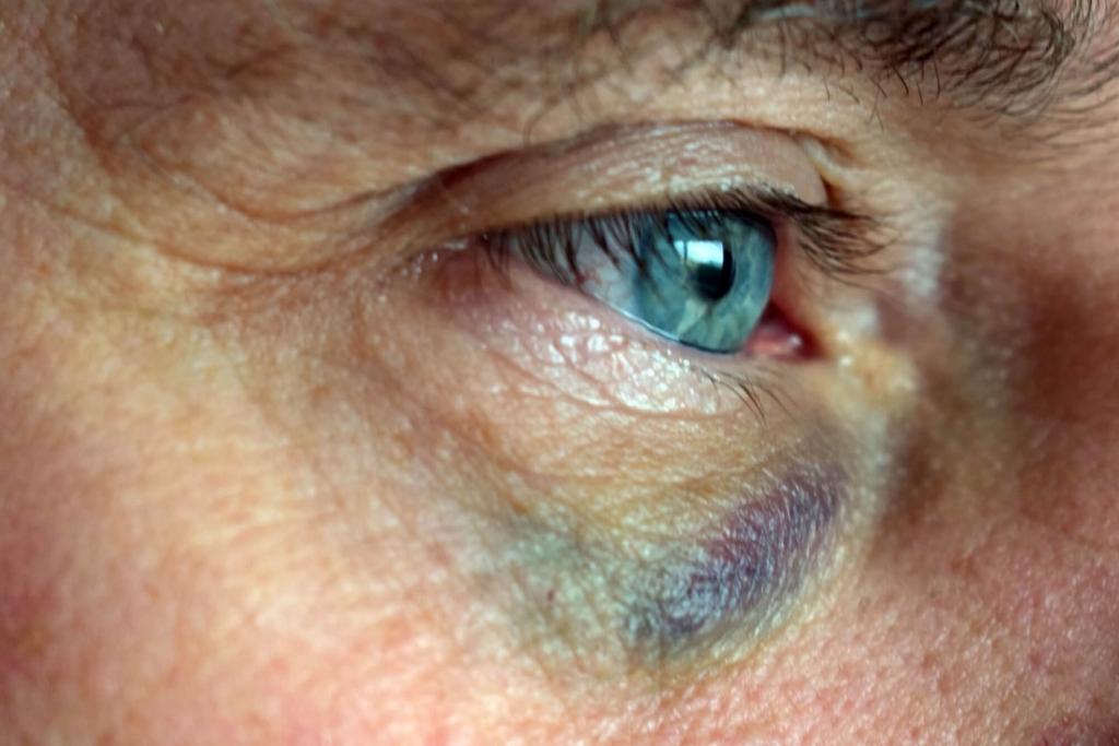Unexplained bruising outlet around eye socket