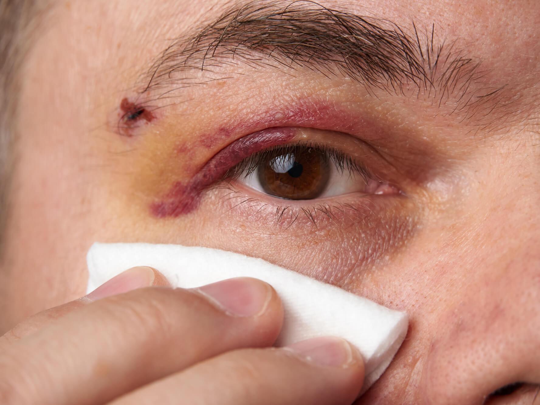 Black eye What causes it and how to treat it