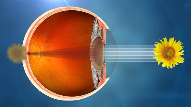 Illustrative visualization of an eye suffering from cataract.