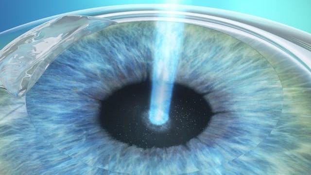 Lasek top eye surgery