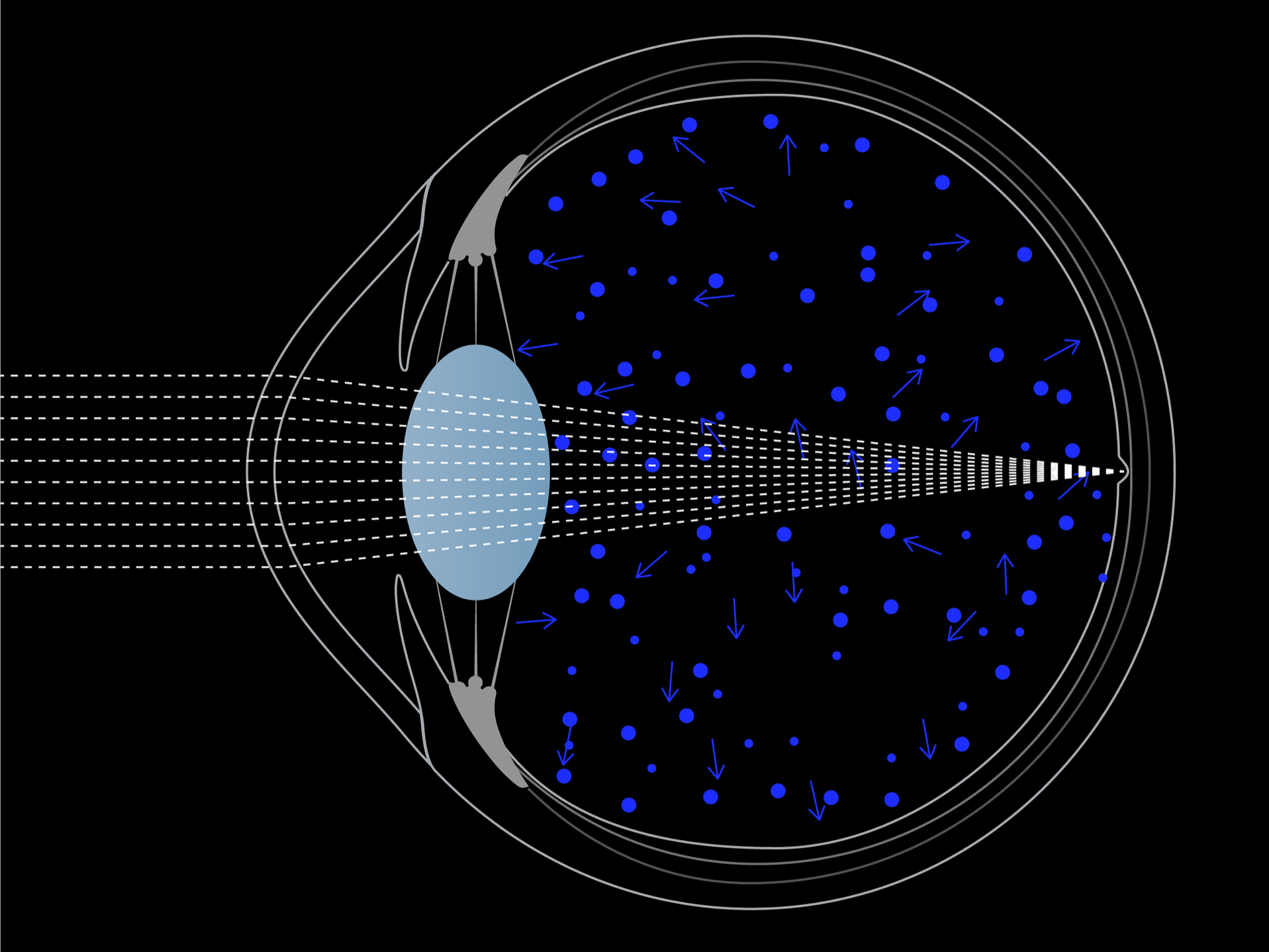 Longitudinal chromatic aberrations of blue light may also lead to visual discomfort.