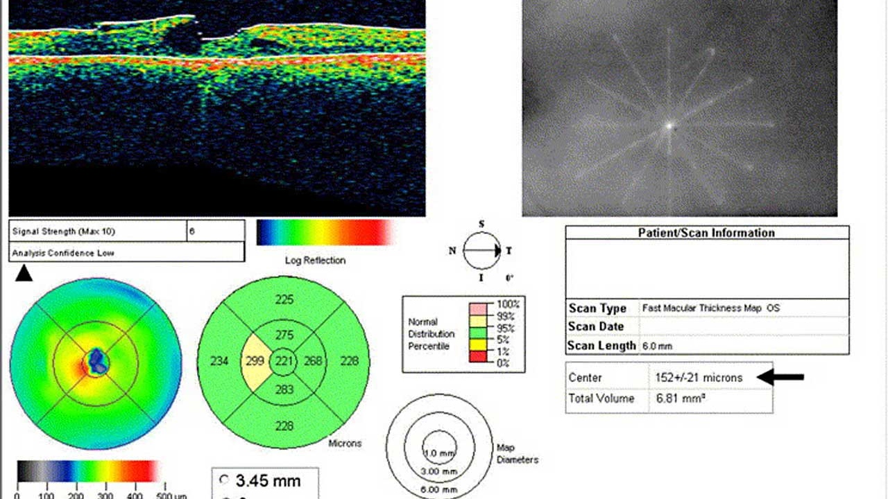Optical coherence tomography (OCT)