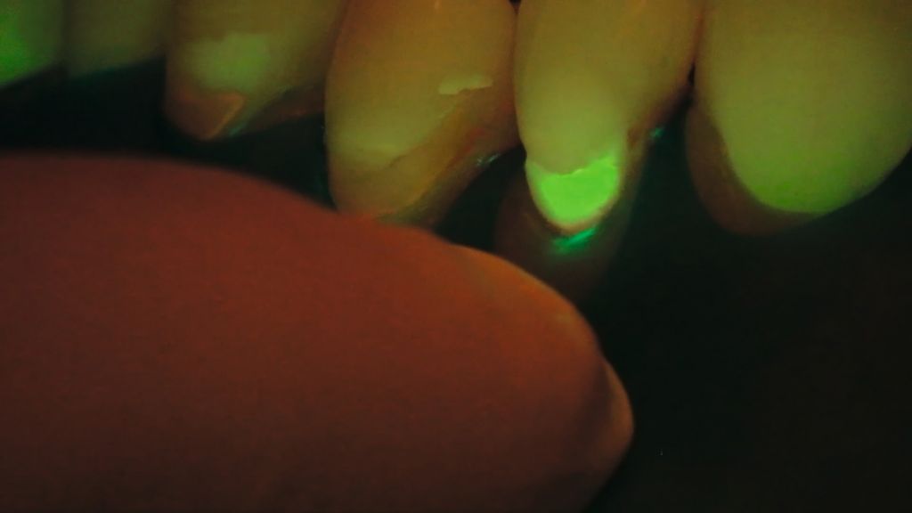 Identification of the border between natural and artificial tooth material using the Fluorescence Mode