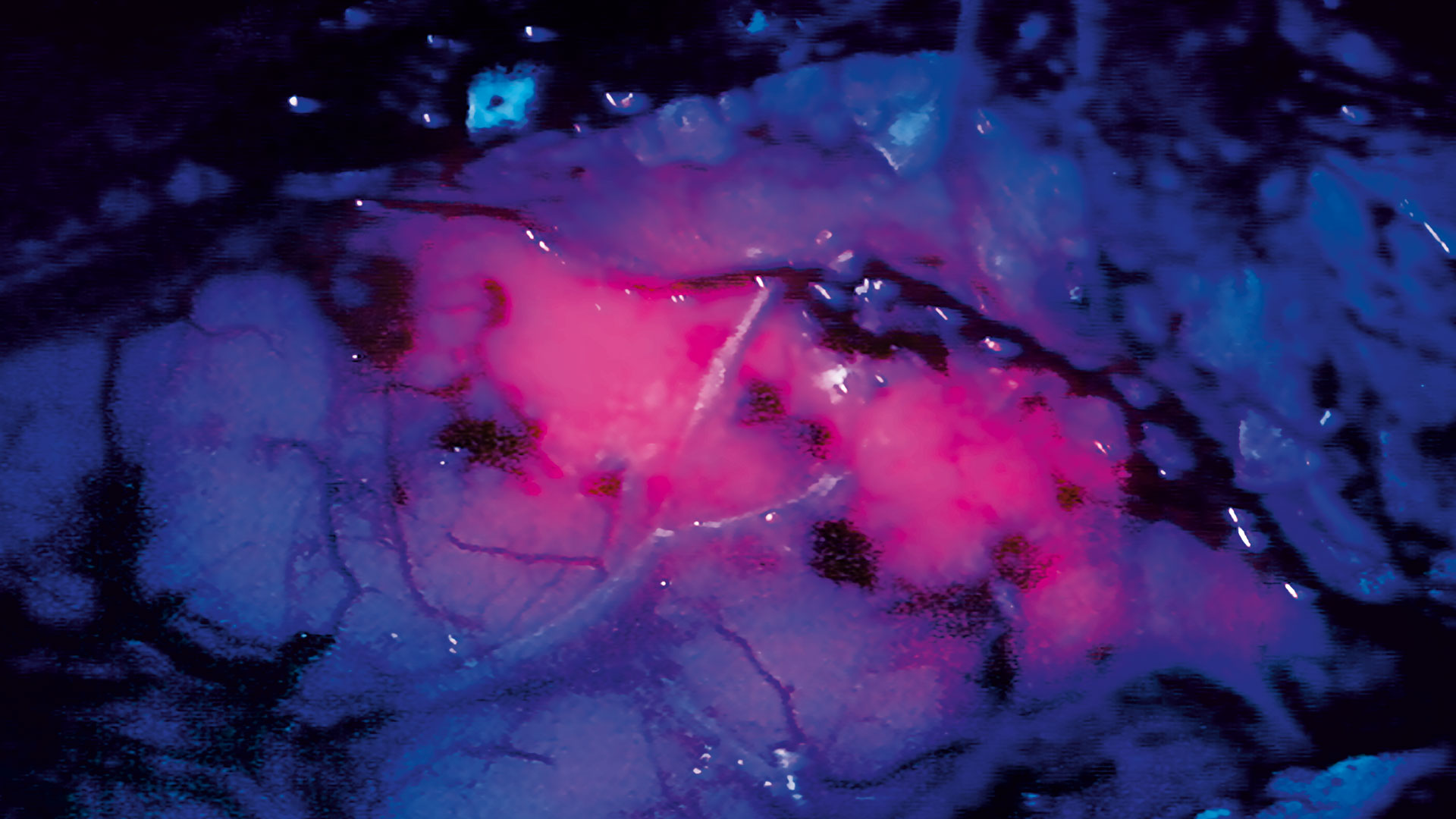 Depiction of a tumor under fluorescent light (BLUE 400 - the red areas indicate the tumor) and under normal lighting conditions (second image).