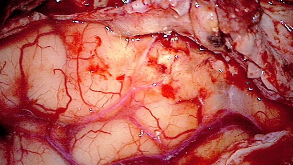Depiction of a tumor under fluorescent light (BLUE 400 - the red areas indicate the tumor) and under normal lighting conditions (second image).