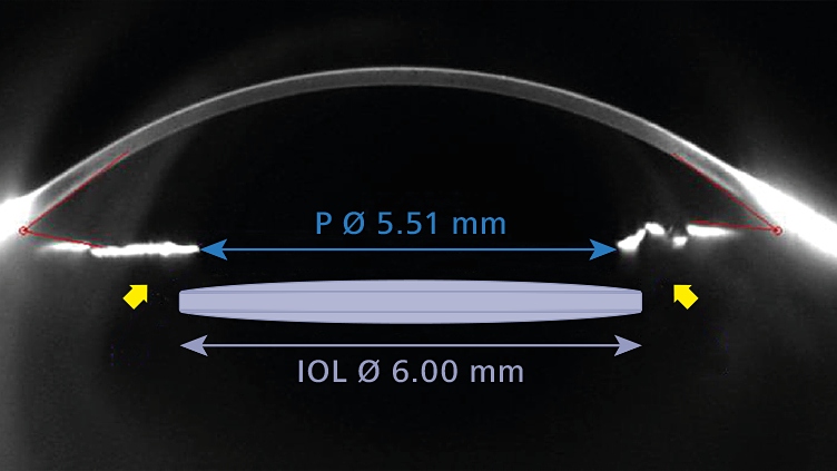 Picture showing that the IOL is  not centered in the middle of the pupil.