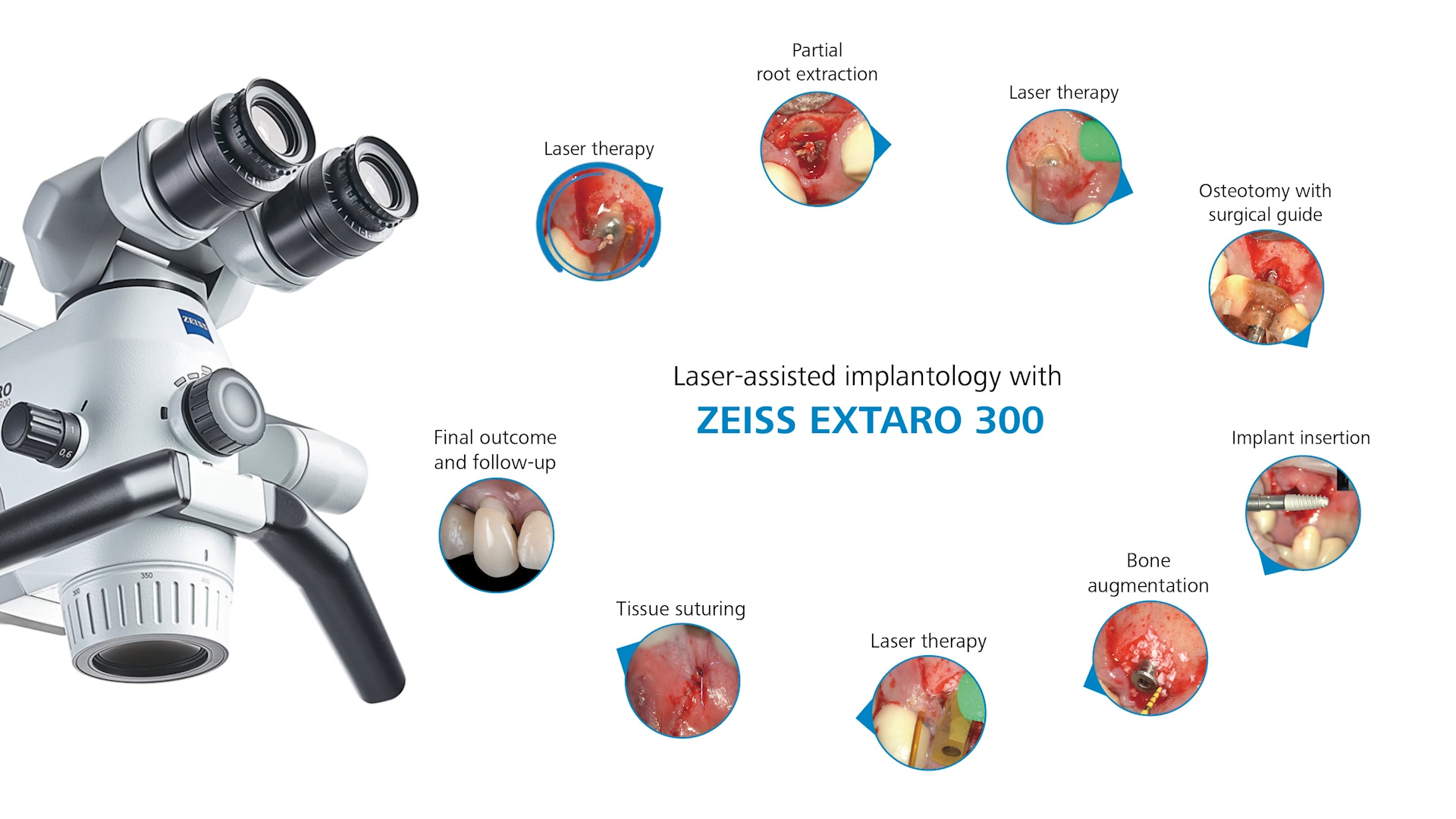 Implantología asistida por láser con ZEISS EXTARO 300