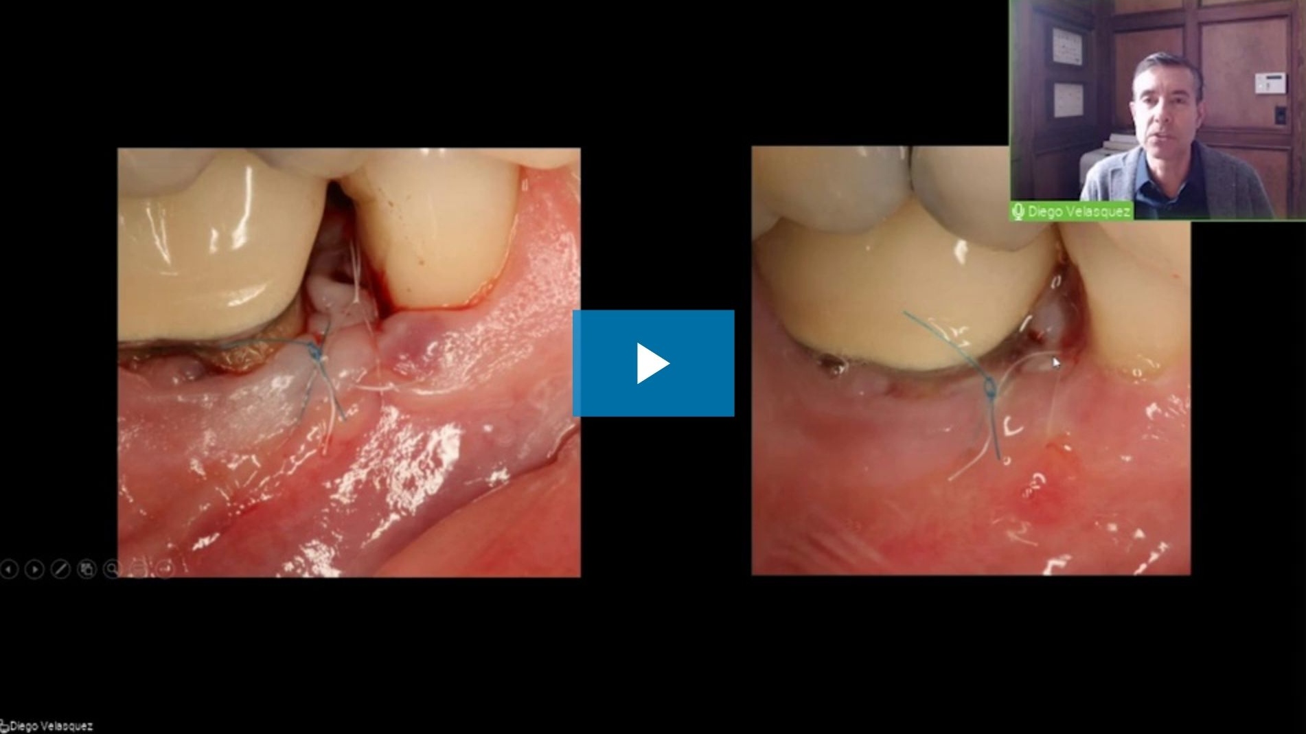 619-dental-week-2021-periodontics-webinar-by-dr--diego-velasquez_preview.jpg