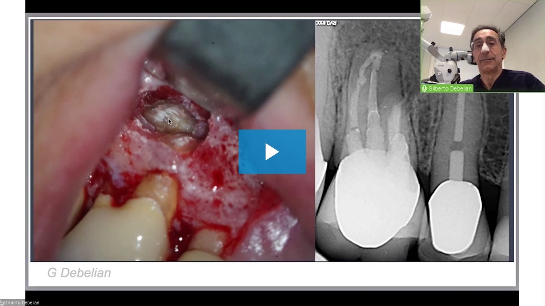 618-dental-week-2021-endodontic-webinar-by-dr--gilberto-debelian_preview.jpg
