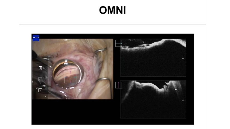 Take a closer look: How to benefit from intraoperative OCT