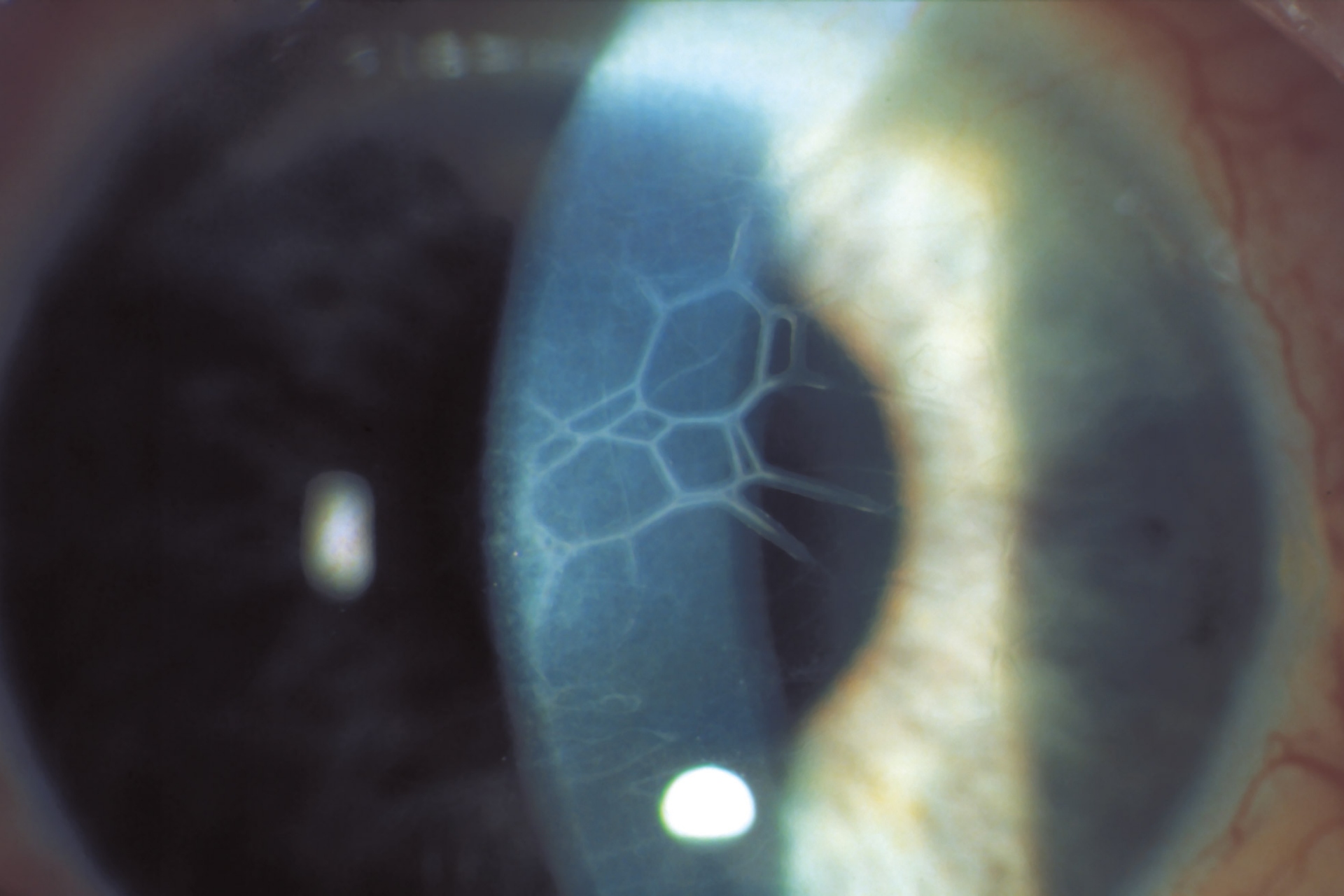 Corneal structures in direct focal illumination