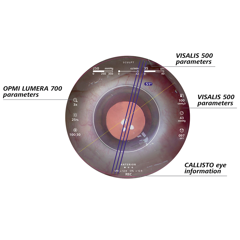 Fonctions d'assistance à chaque étape de la chirurgie de la cataracte