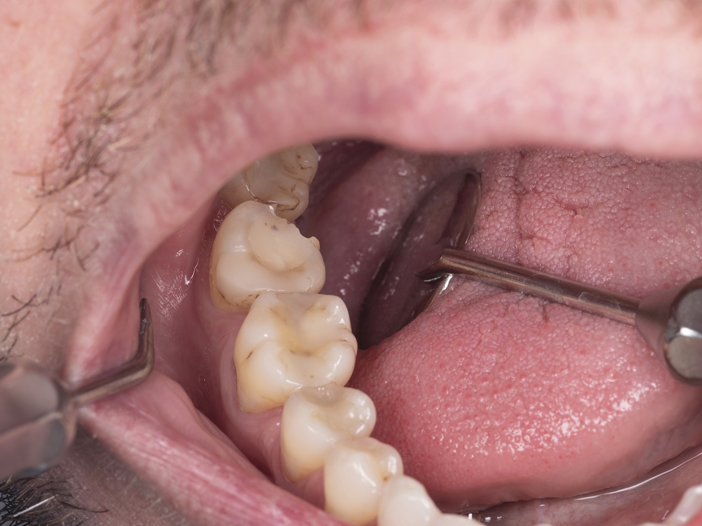 Tooth preparation challenges: Common errors and easier diagnostic 