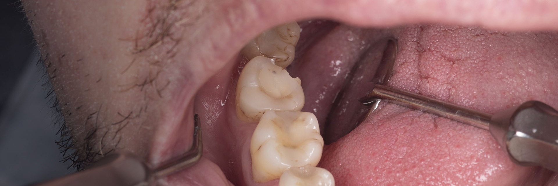 The pitfalls of tooth preparation – can you see it?