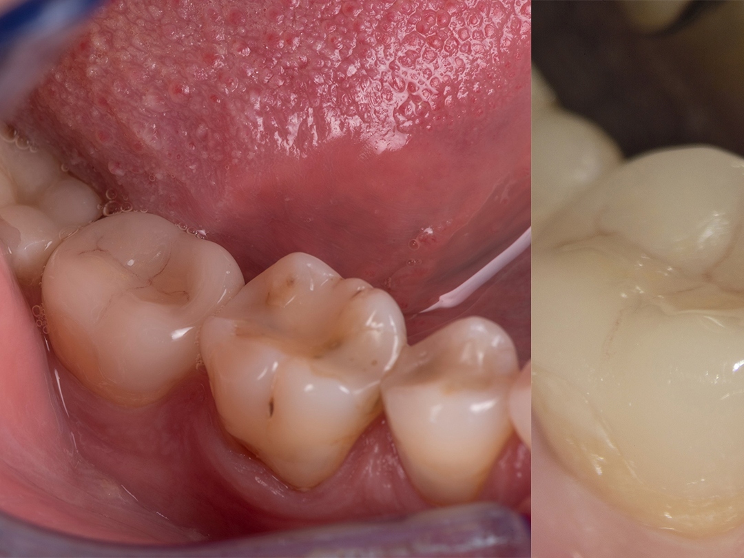 Try-in and cementation without magnification (left) and with high magnification (right)