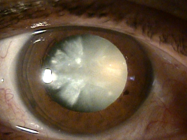 Femme de 64 ans présentant une cataracte intumescente blanche et dense