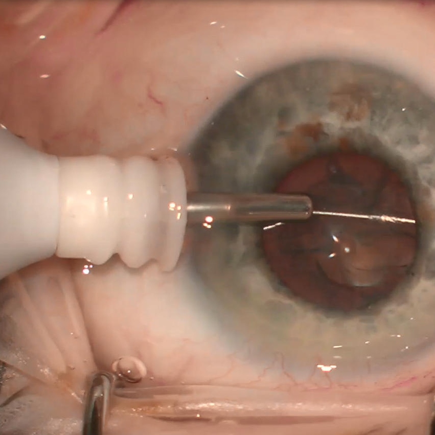 Lens fragmentation of a cataract using ZEISS miLOOP; image courtesy of Florian Kretz, MD, DEU