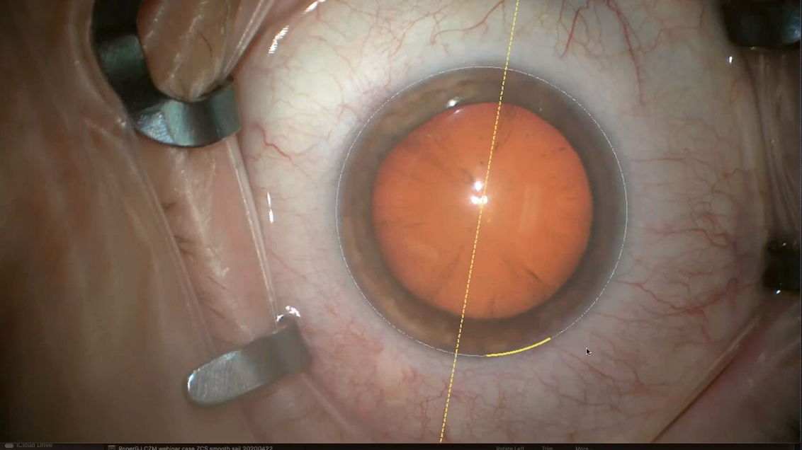 Workflow efficiency in the OR - Pearls in using the ZEISS CALLISTO eye