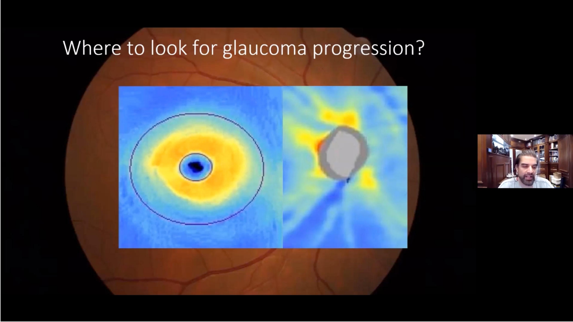 Glaucoma Progression 