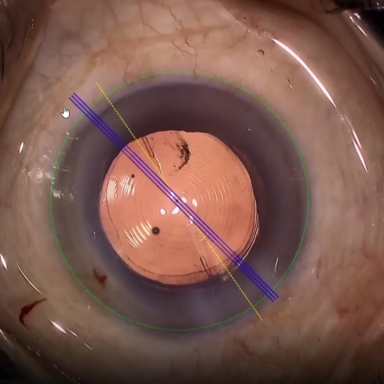 ZEISS cataract surgery Exceeding expectations of premium cataract patients