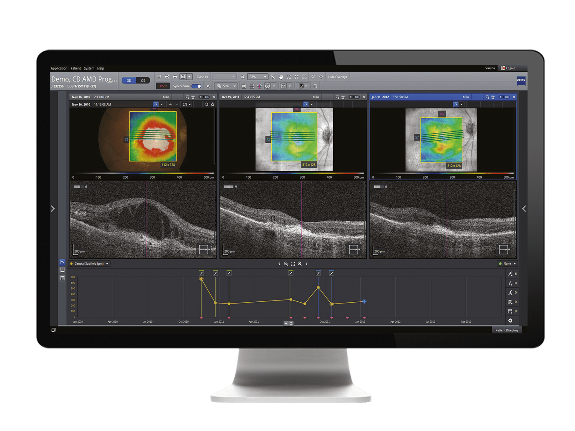 ZEISS Retina Integrating multi-modality data efficiently