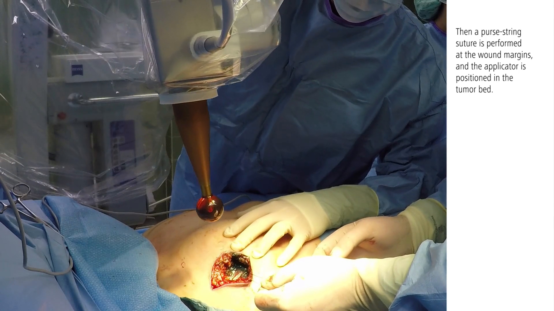 IORT live case breast cancer