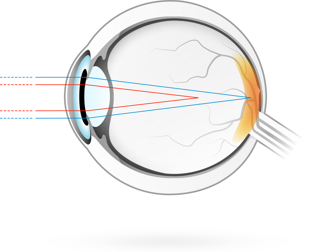 Astigmatism – condition in which the cornea's curvature is asymmetrical, so light rays are focused at two points rather than one, resulting in blurred vision