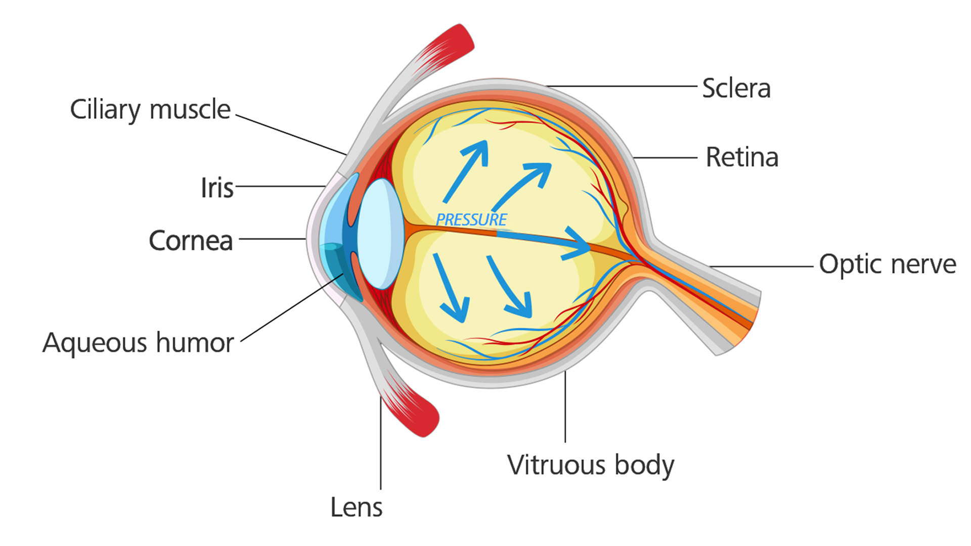 Eye with glaucoma: Eye pressure builds up and causes damage to the optic nerve.