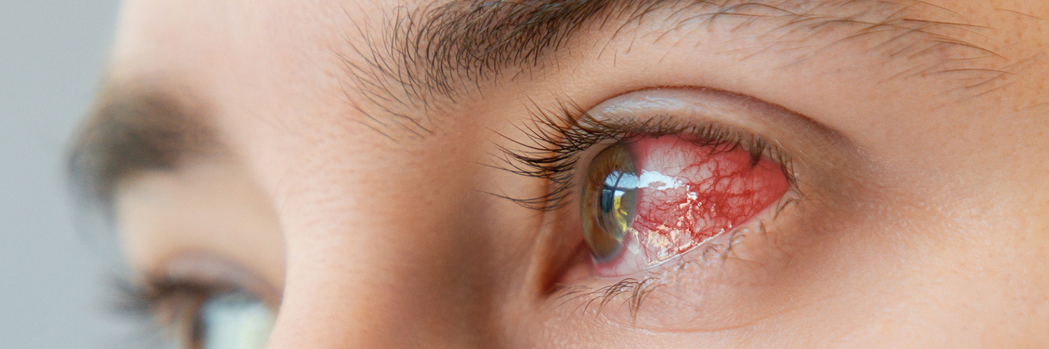 Close up of male brown bloodshot eyes and redness with vessels. Concept of keratitis, inflammation and ophthalmology