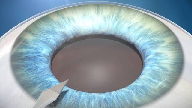 Incision of the cornea during cataract surgery.
