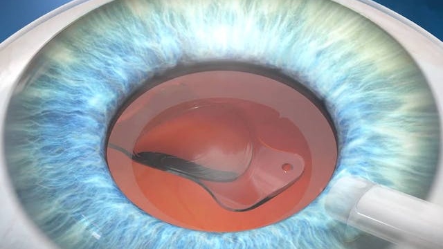 Insertion of an intraocular lens (IOL) during cataract surgery.