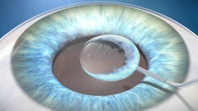 Injection of Ophthalmic Viscosurgical Devices (OVDs) during cataract surgery.