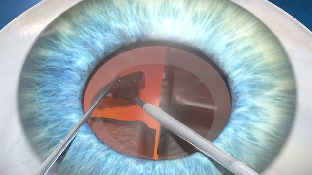Removal of the cataract lens during surgery.